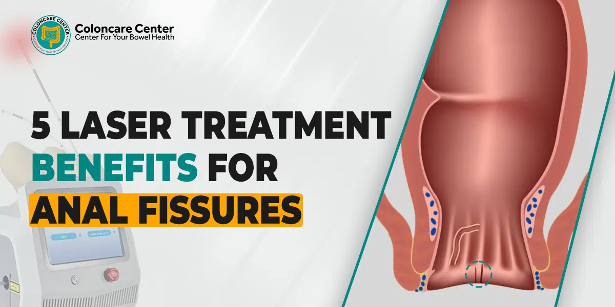 5 Laser Treatment Benefits for Anal Fissures You Need to Know