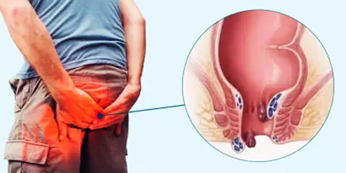 Common Symptoms of Piles Disease